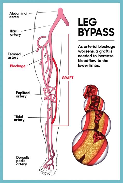 Leg Bypass Surgery The Ottawa Hospital Foundation