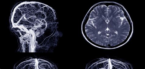 More Awareness Needed About Stroke Risk After Mini Stroke University