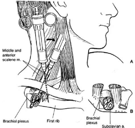 Figure 1 From Supraclavicular Brachial Plexus Blocks Review And