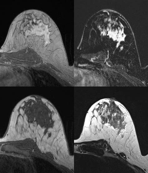 Invasive Lobular Carcinoma — Clinical Mri