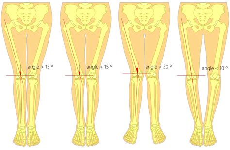 Unequal Leg Length Discrepancy Treatment Fix Back Hip And Knee Pain