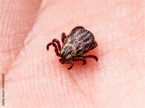 Infected Tick Insect Crawling On Skin Encephalitis Virus Or Lyme
