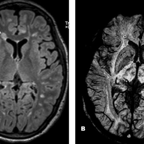 Mri Of An Ms Patient A Flair Image Demonstrating A Deep White Matter
