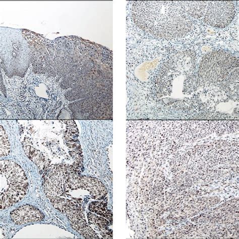 P16 Immunohistochemical Staining In In Adenocarcinoma Of Uterine Cervix
