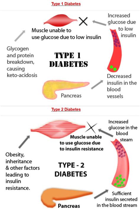 Diabetes Type 1 Diabetes Vs Type 2 Diabetes Visually