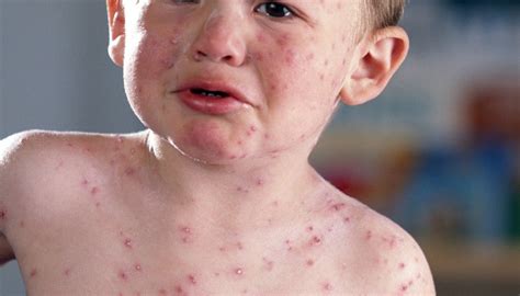 How To Prevent And Treat Infant Neck Rash How To Adult