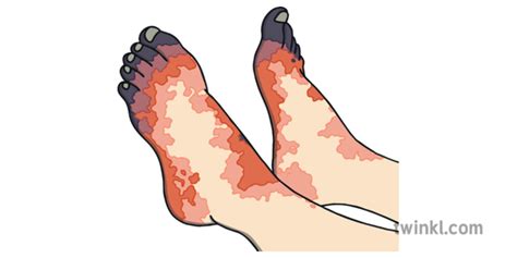 Trench Foot Illustration Twinkl
