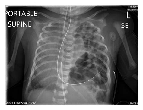Chest Radiograph Showing Left Diaphragmatic Hernia And Contralateral Download Scientific