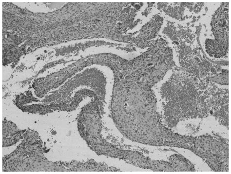 A Giant Aneurysmal Bone Cyst Of The Rib Case Report