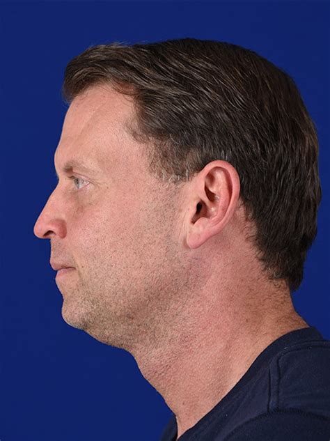 patient 17342419 male facial rejuvenation before and after photos shapiro plastic surgery