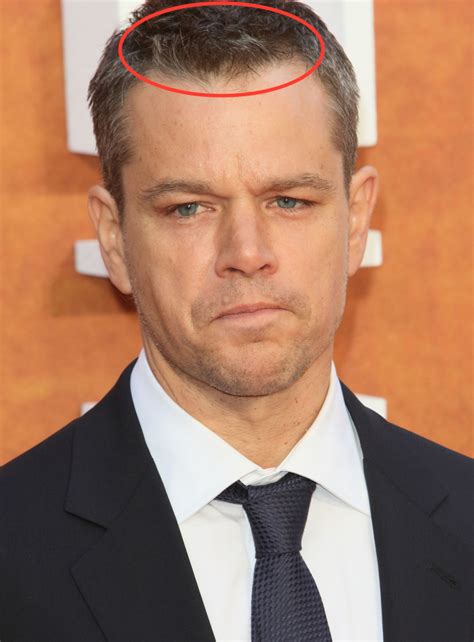 Celebrity Hair Loss Is Matt Damon Treating His Hair Loss