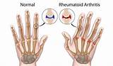 Images of What Doctor Treats Rheumatoid Arthritis