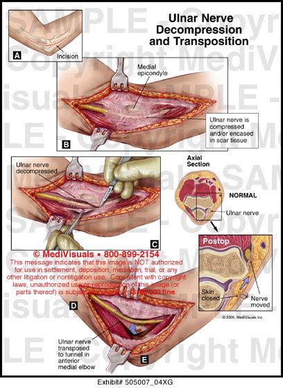 Ulnar Nerve Decompression And Transposition Medivisuals