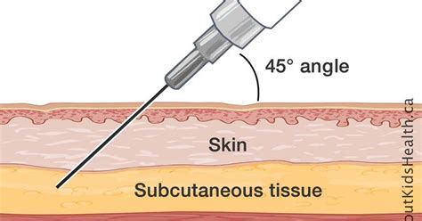 Pin By SkinKare By Kate On Integumentary System Subcutaneous Tissue