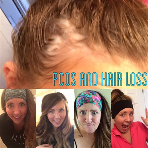 How To Control Hair Fall In Pcos Naturally Tips And Tricks Best Simple Hairstyles For Every