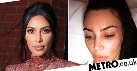 Kim Kardashian Gets Skin Tightening Treatment After Psoriasis Flare Up
