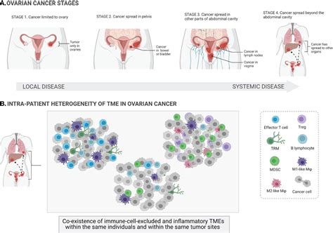 Frontiers Integration Of Local And Systemic Immunity In Ovarian