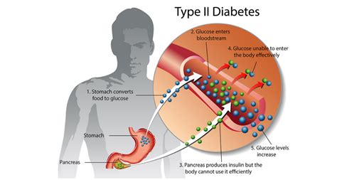 How To Prevent Treat And Manage Type 2 Diabetes Mellitus Hubpages