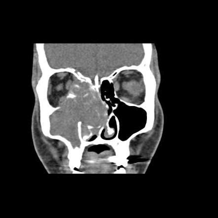 Sinonasal Undifferentiated Carcinoma Radiology Reference Article Radiopaedia Org