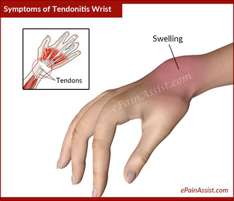 Tendonitis Wrist Or Wrist Tendinitiscausessignssymptomstreatment