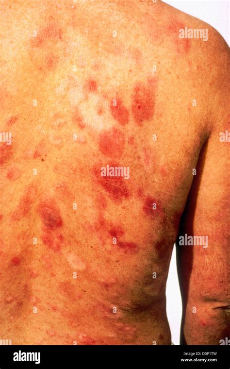 Kaposis Sarcoma Are Common Opportunistic Side Infection People Hiv