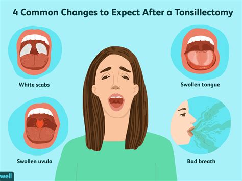 Uvula Infection Symptoms