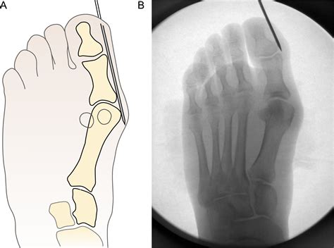 Radiographic Outcomes Of A Percutaneous Reproducible Distal Metatarsal Osteotomy For Mild And