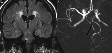 A Mri Shows Subacute Infarct Over Right Pons Arrow B Mra Shows