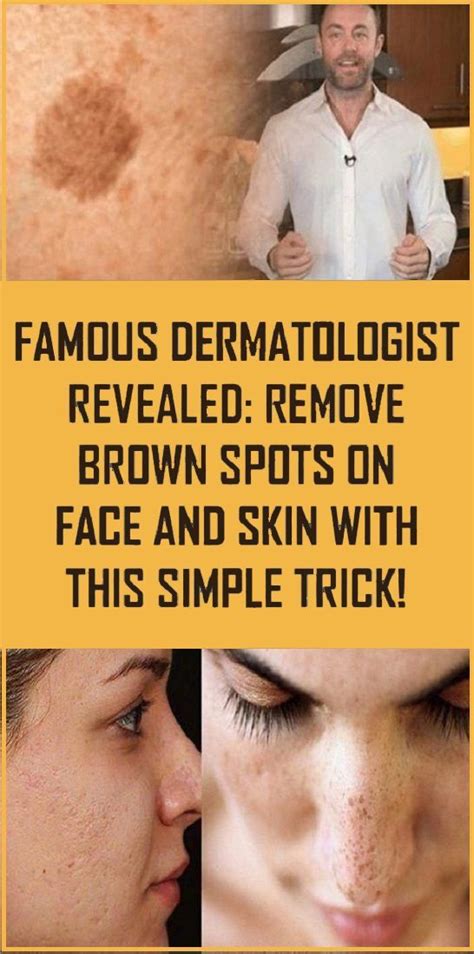 Get Rid Of The Brown Marks On Your Skin With This Simple Trick Health
