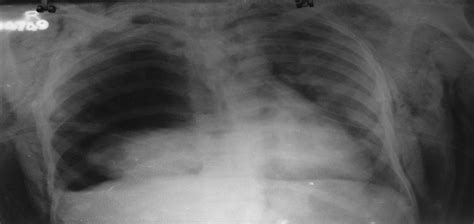 Fallen Lung Sign On Chest Radiograph Journal Of Trauma And Acute