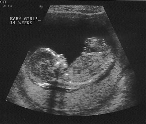 The Life And Times Of A Tyner 14 Week Ultrasound Pictures