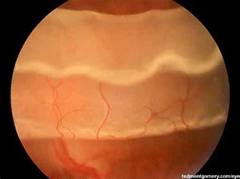 Retinal tears can develop at any age, but. Retinal Tear: #2