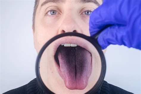 Closeup Of A Man Black Tongue Clinical Manifestations Of Lingua Villosa