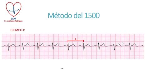 Calcular La Frecuencia Cardiaca En Electrocardiograma Mobile Legends