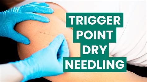 Trigger Point Dry Needling Tdn Foothills Sports Medicine Physical