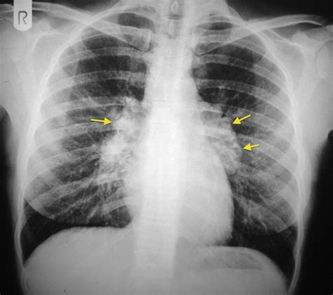 A Chest X Ray Bilateral Hilar Lymphadenopathy B C Ct