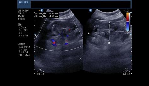 What Do The Colors Mean On A Kidney Ultrasound The Meaning Of Color