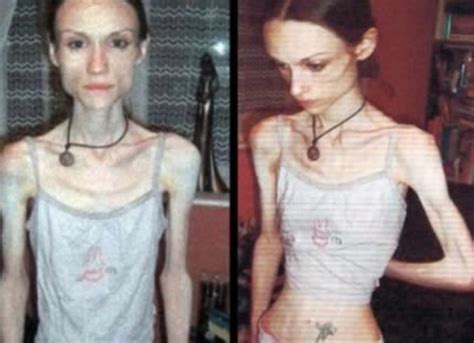 She Would Walk 12 Hours A Day To Lose Weight Health 10 Most Terrible Cases Of Anorexia