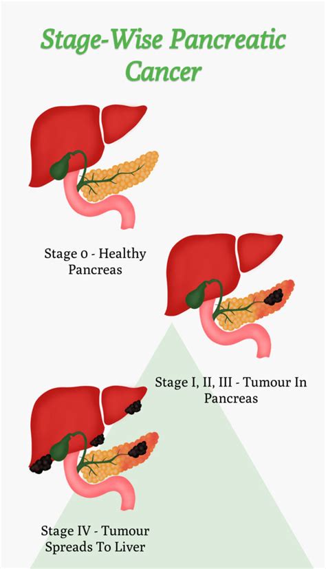 Pancreatic Cancer Treatment In India Advanced Care Options