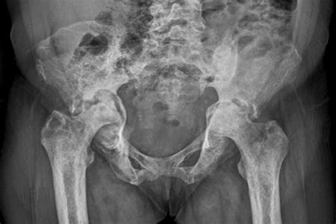 Orthopaedic Clinic Avascular Necrosis Of The Hip In Adults Pulse Today