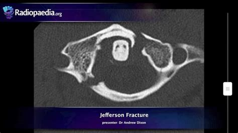 Jefferson Fracture Radiology Video Tutorial X Ray Ct Youtube
