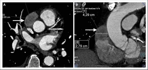Figure 1 From Rare Case Of An Intrapericardial Ectopic Thyroid Struma