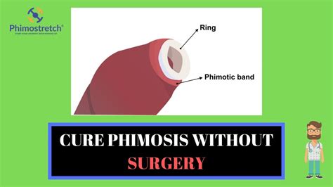 Cure Phimosis And Solve Tight Foreskin Without Circumcision Phimostretch An Introduction