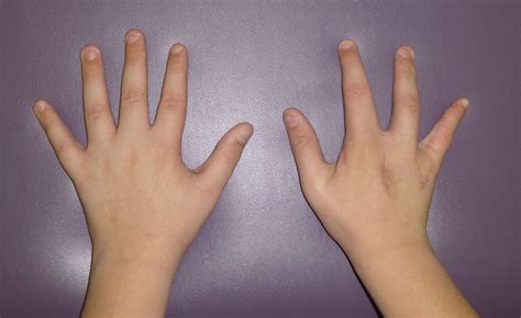 Cleft Hand Long Term Follow Up Congenital Hand And Arm Differences