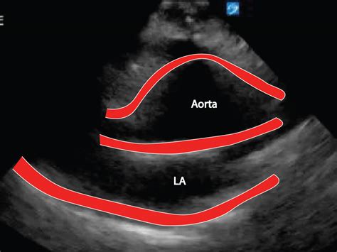 Discovering The Aorta Through Ultrasound Critical Care Sonography