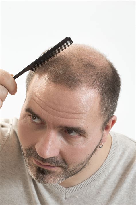 Your style of hair can cause hair loss when your hair is arranged in ways that pull on your roots, like tight ponytails, braids, or corn rows. 5 REASONS TO SHAVE YOUR HEAD TODAY!