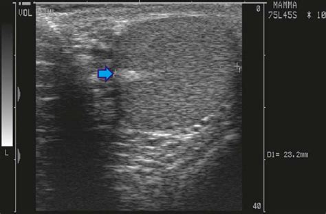 Ultrasound Print Of A Transverse Scan Of Normal Testis With A Slightly