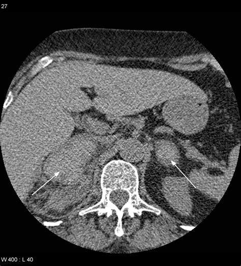 Adrenal Mass Incidental On Ct