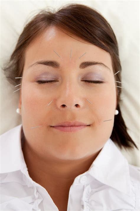 Gesichtsschönheits Akupunktur Behandlung Stockbild Bild Von