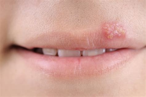 How To Treat Cold Sores Naturally Alternative Drmcare